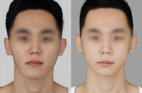 Hình ảnh trước và sau thẩm mỹ 2