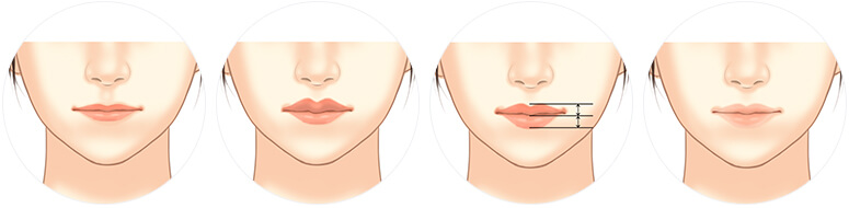 Tạo hình thẩm mỹ môi
