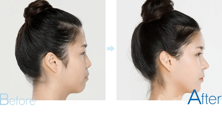 Khắc phục các khuyết điểm của trán